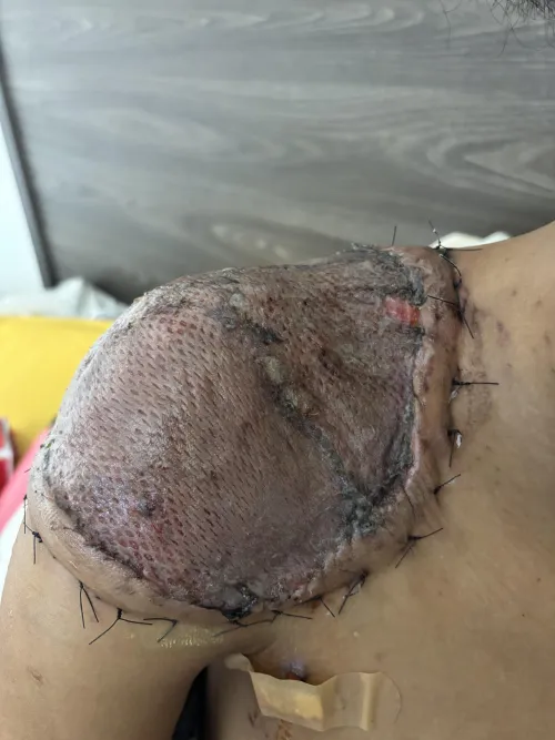 STSG Dermatofibrosarcoma