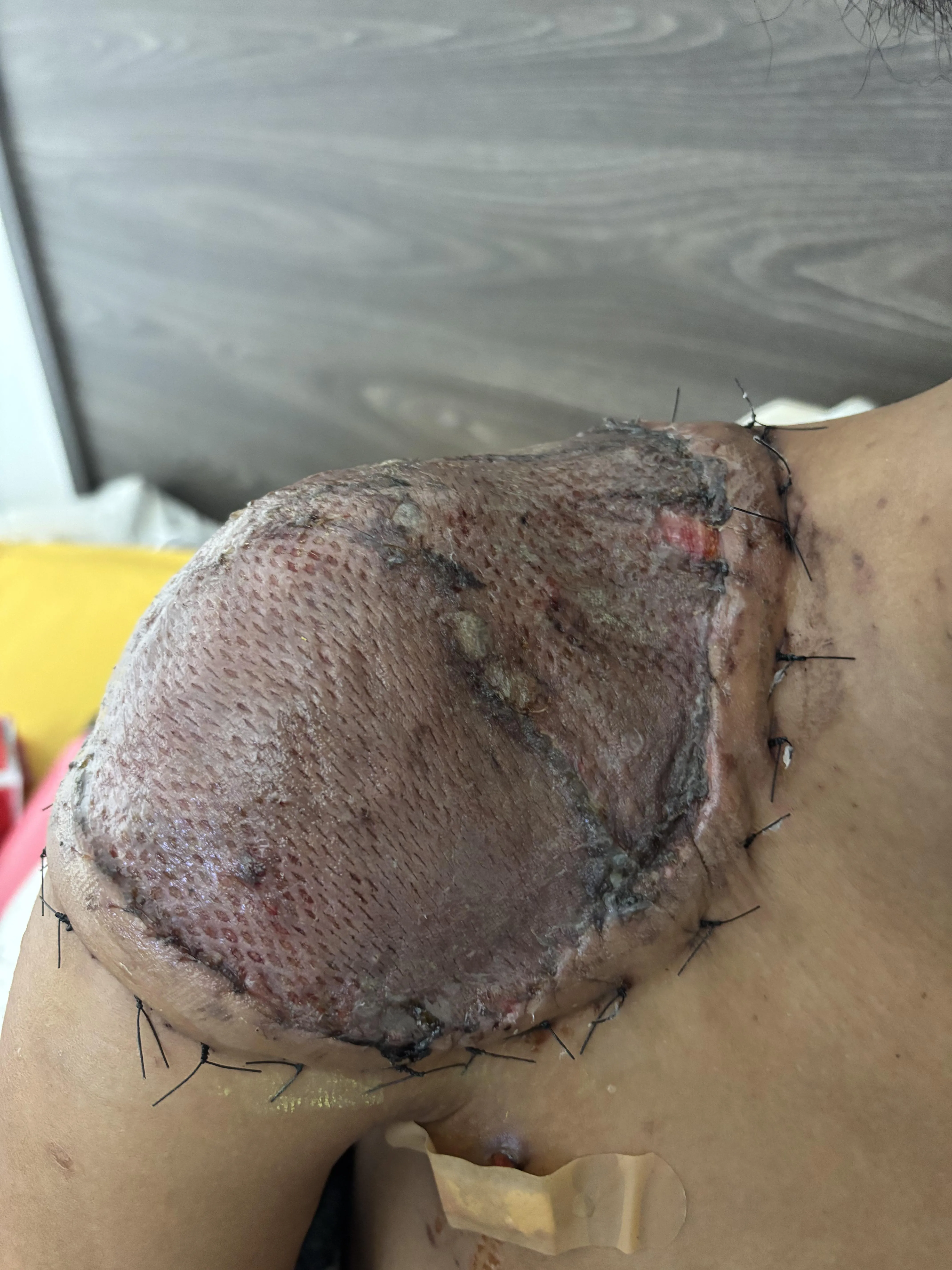 STSG Dermatofibrosarcoma