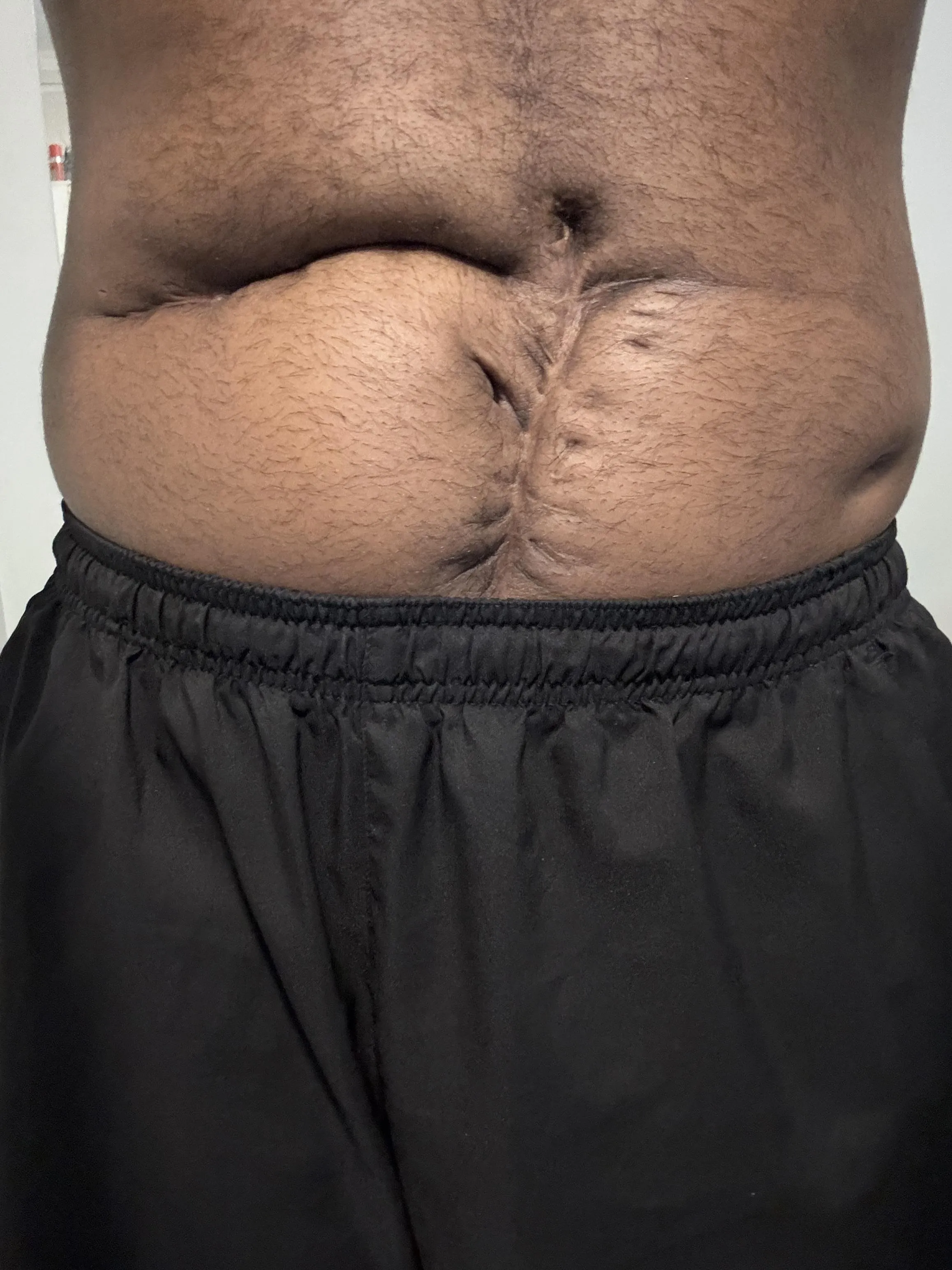 Surgery I had when I was 15 days old. I’m 22 years old now.