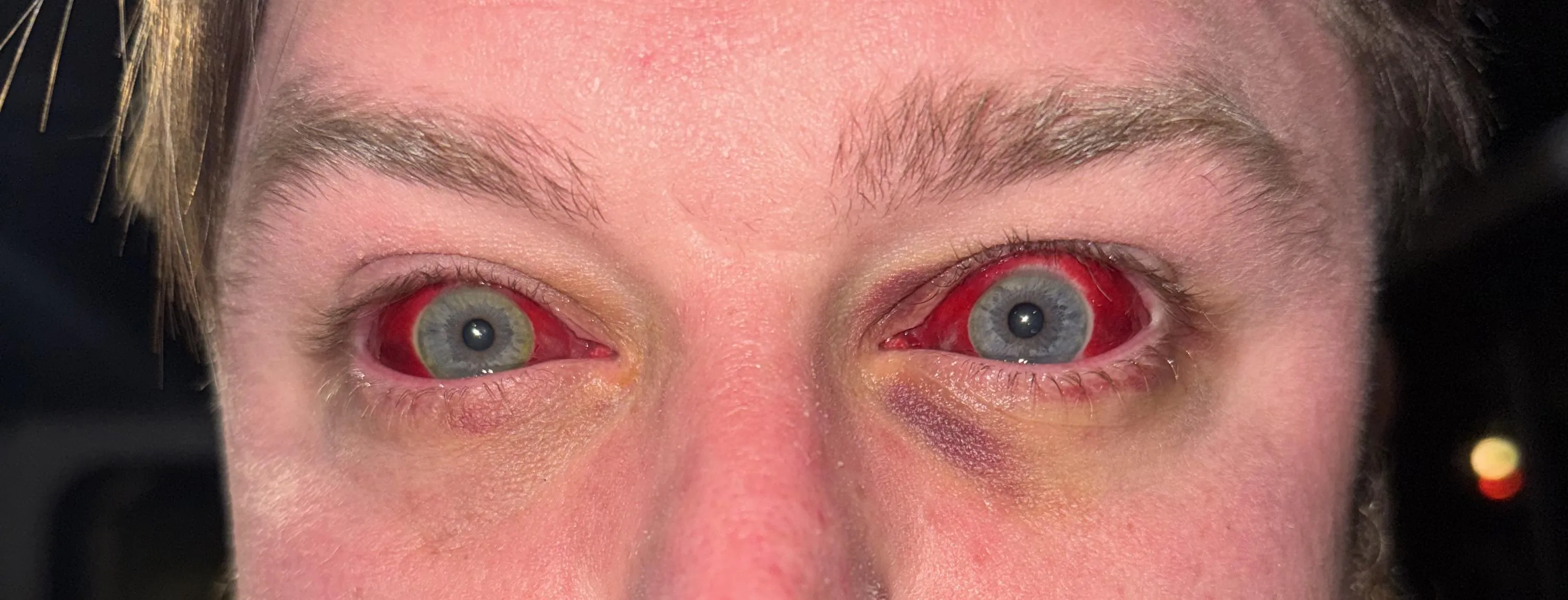 A lil ocular hemorrhage for your viewing