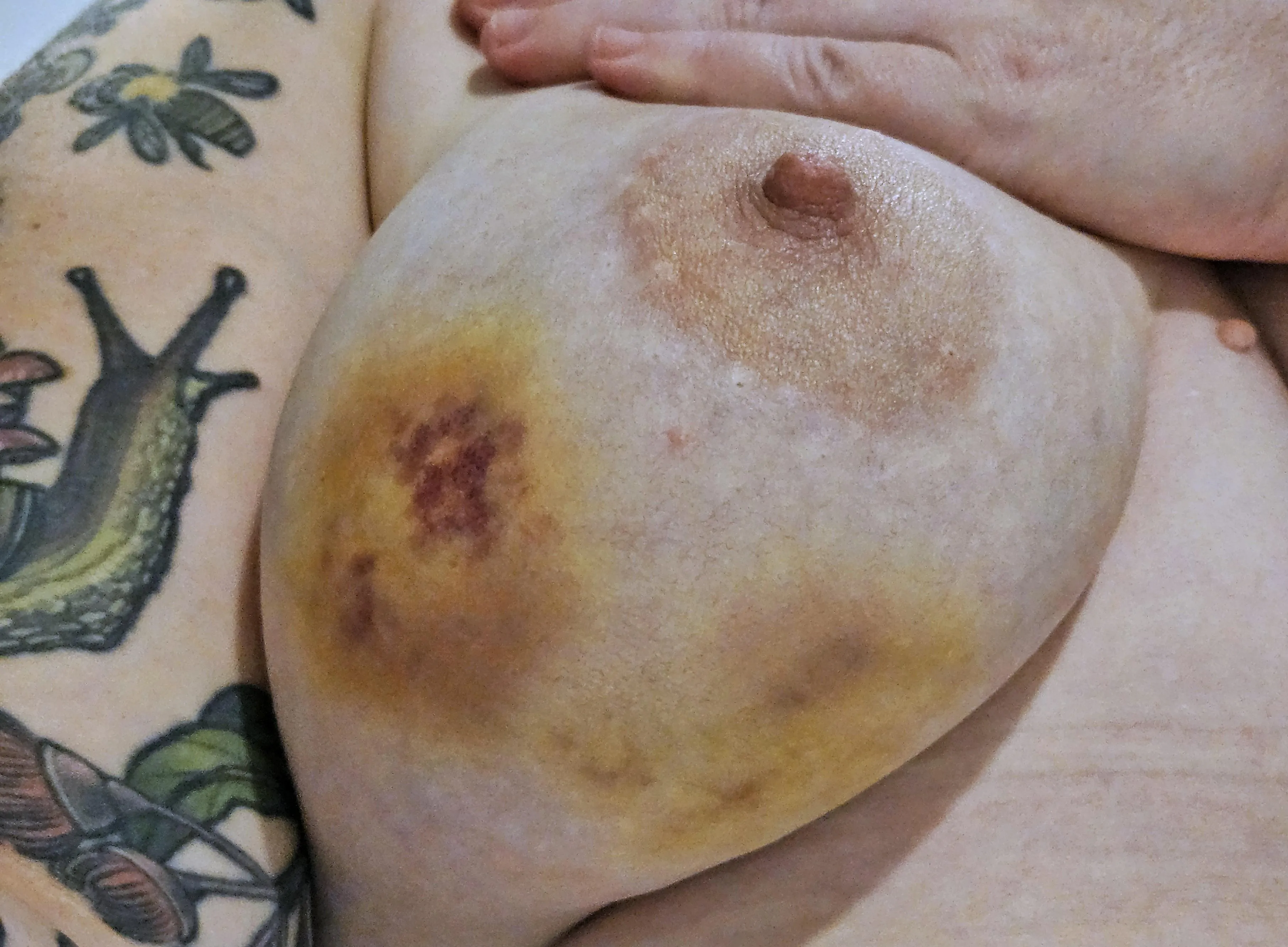 Got some bruises on-top of bruises going on