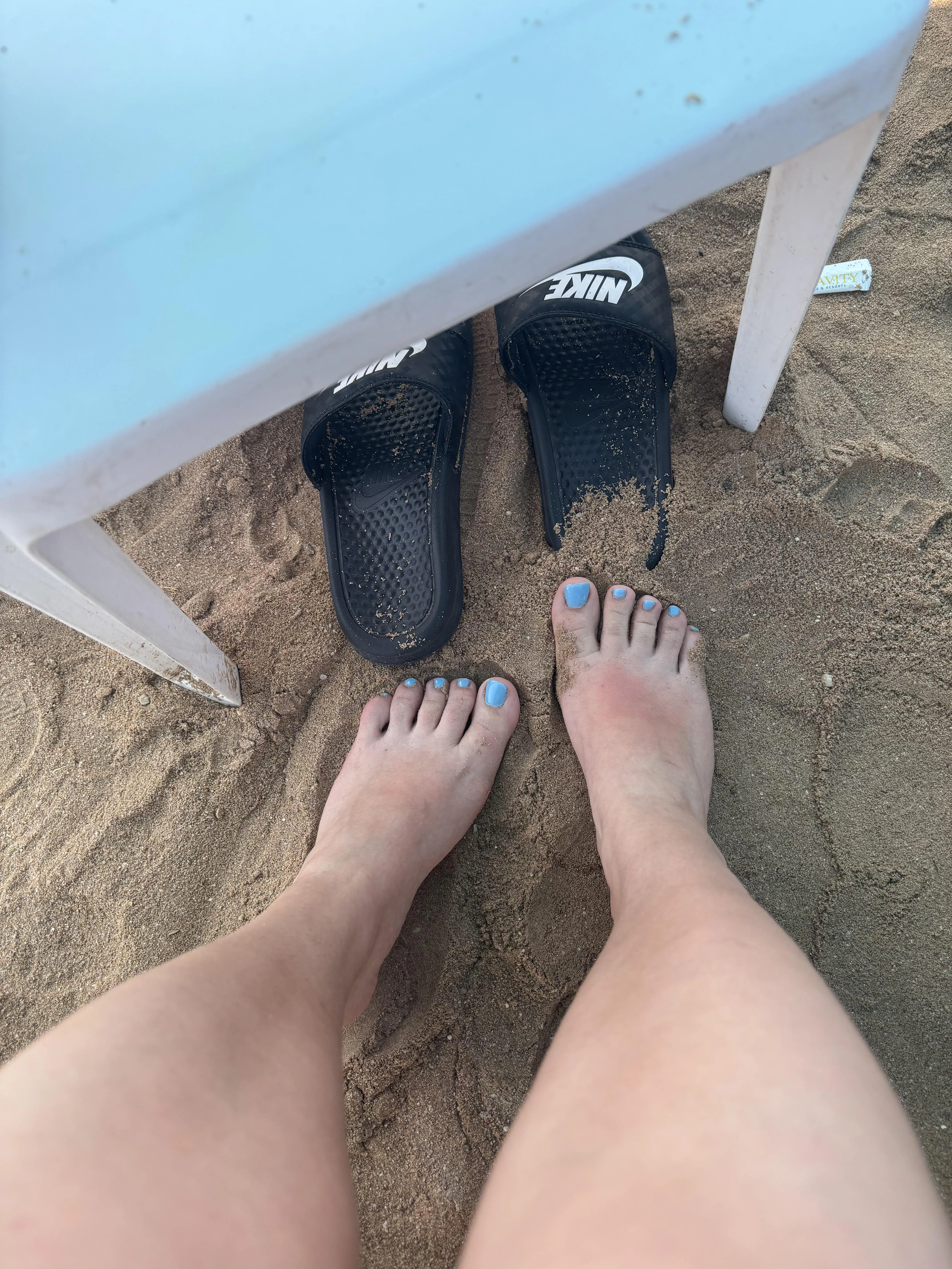 My foot was stung by jellyfish, should someone pee on it?