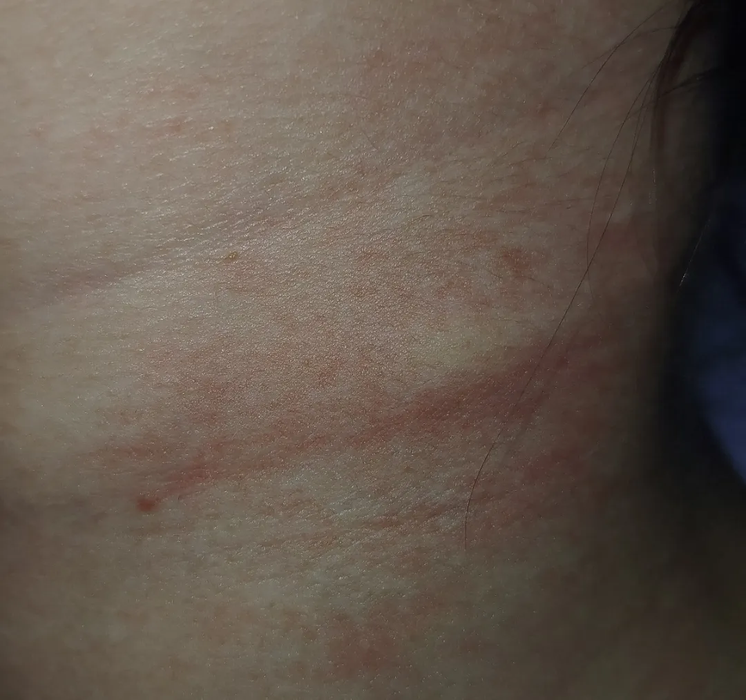 This just suddenly appeared on my neck tonight. I can't think of anything that could have triggered it. It's much more defined irl, and it's itchy.