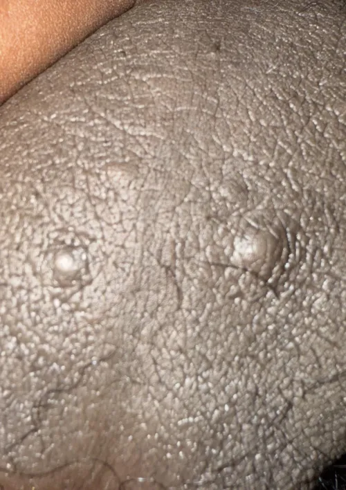 Are the sebaceous cyst on scrotum ?