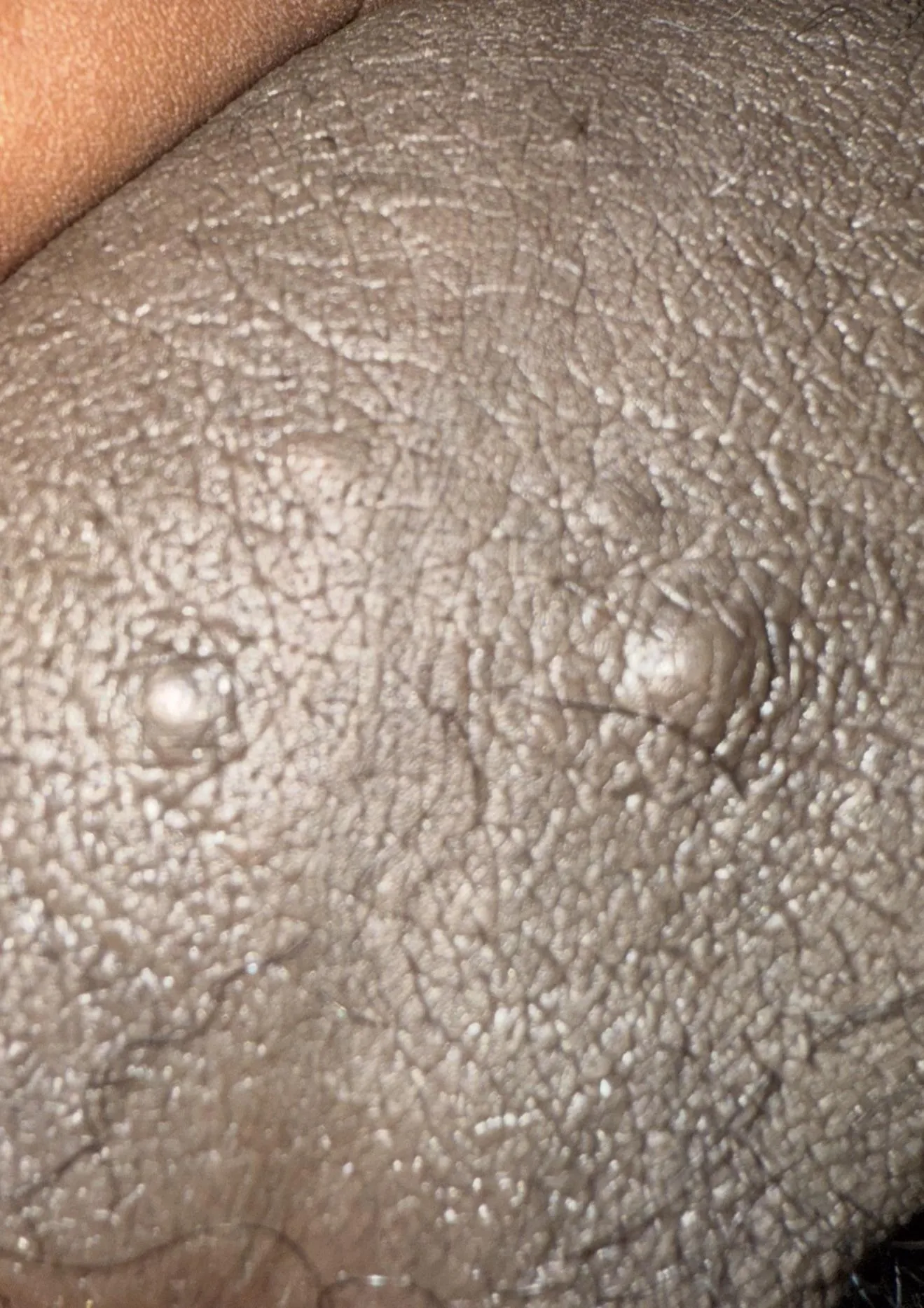 Are the sebaceous cyst on scrotum ?