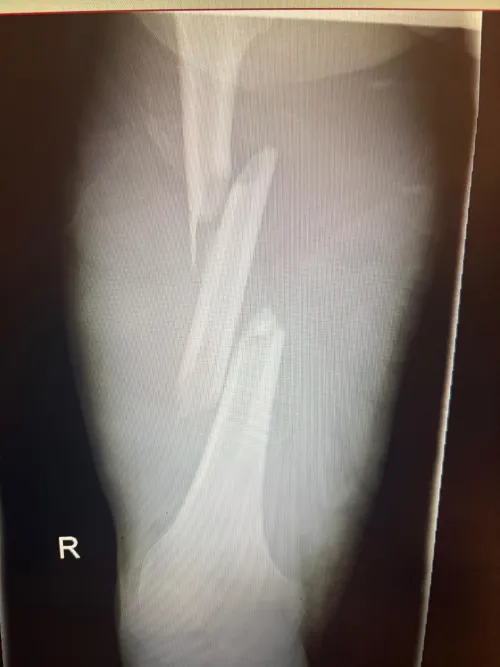 Broken Femur
