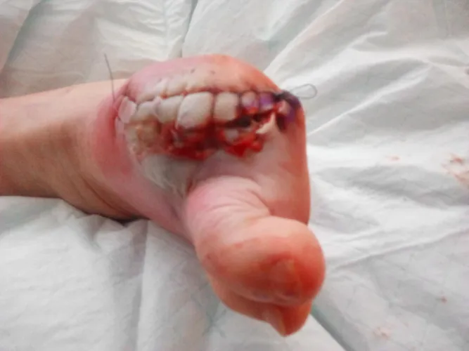 My dads amputated big toe