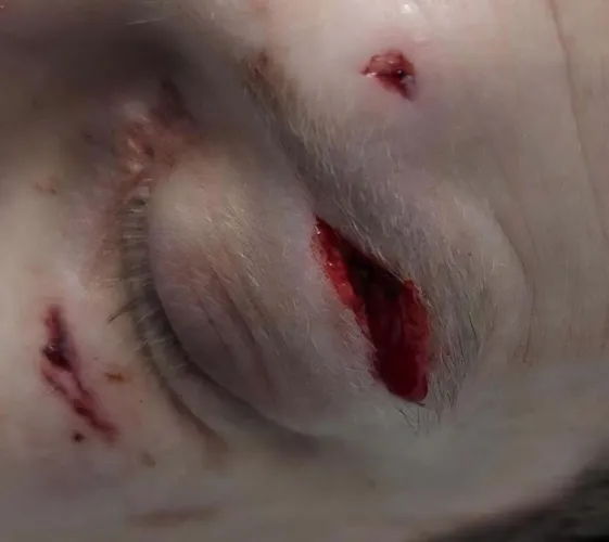 Punched in the face a while ago (guy had a ring on)