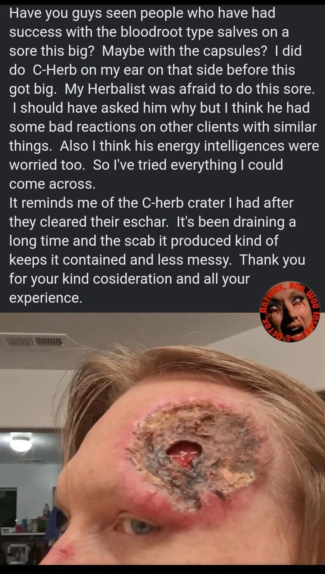 The result of using too much black sale on your forehead.