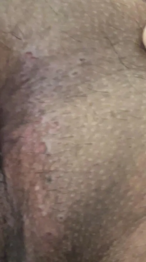 24M, These lacerations, ulcers, or sore started appearing around my rectum. Any idea what it could be?