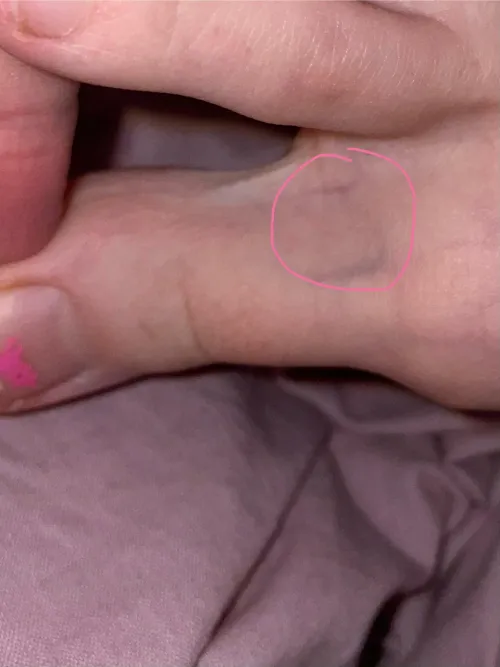 Is this something to be worried about. My toe is kinda numb. Also I have huge health anxiety, so sorry if this post shouldn’t be posted here.