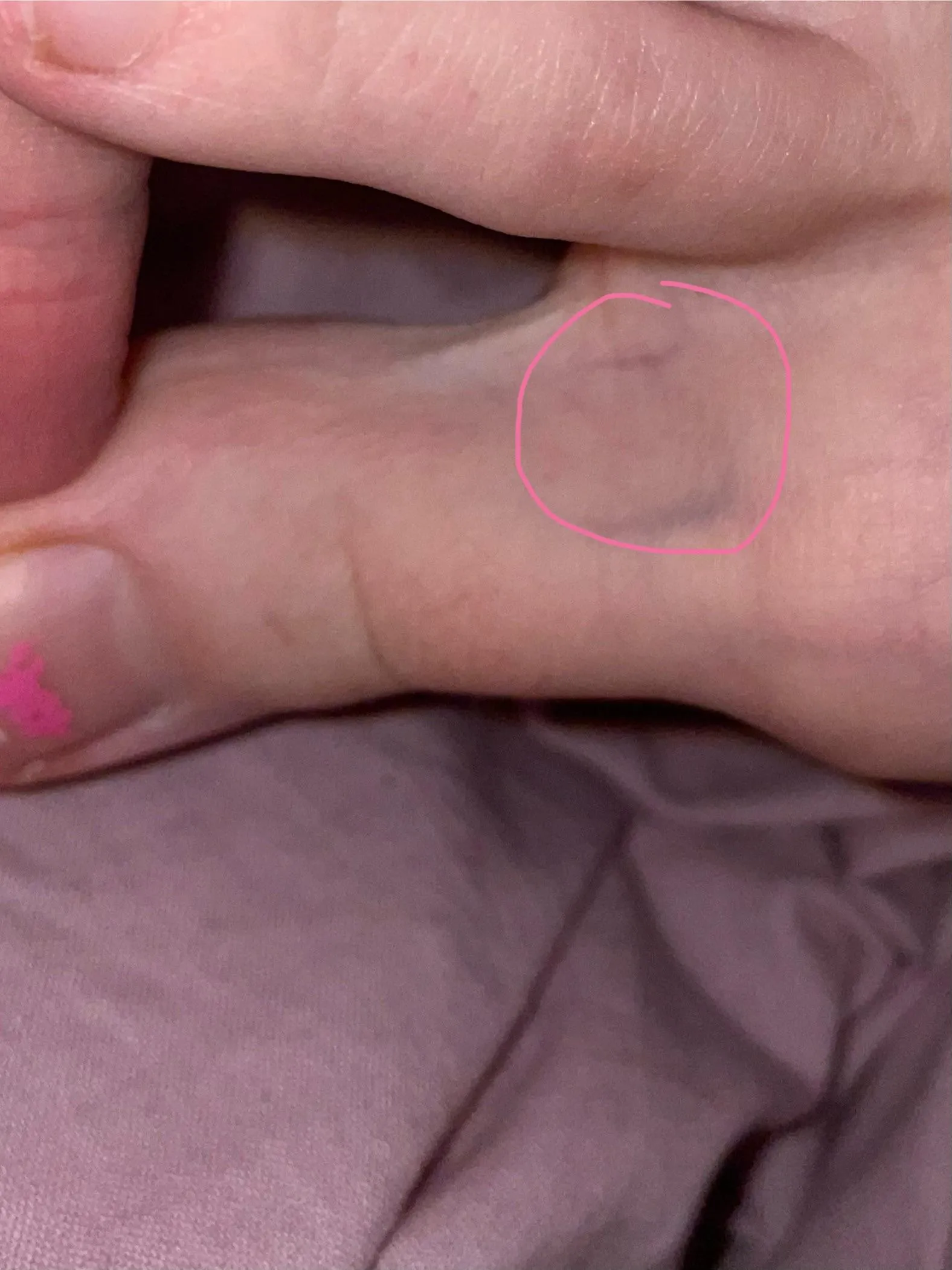 Is this something to be worried about. My toe is kinda numb. Also I have huge health anxiety, so sorry if this post shouldn’t be posted here.