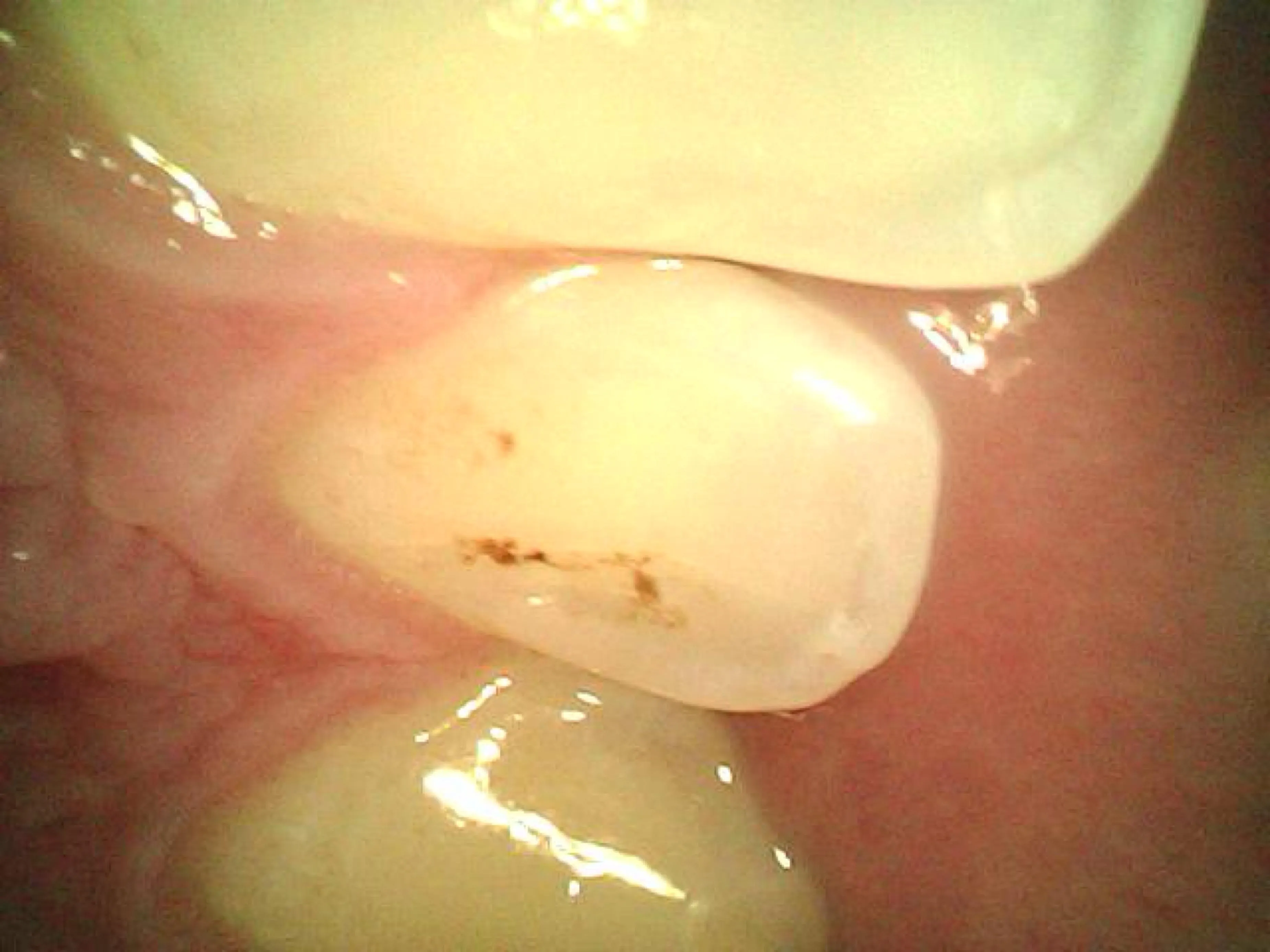 What is the stain behind my front tooth? Dentist did not say anything.