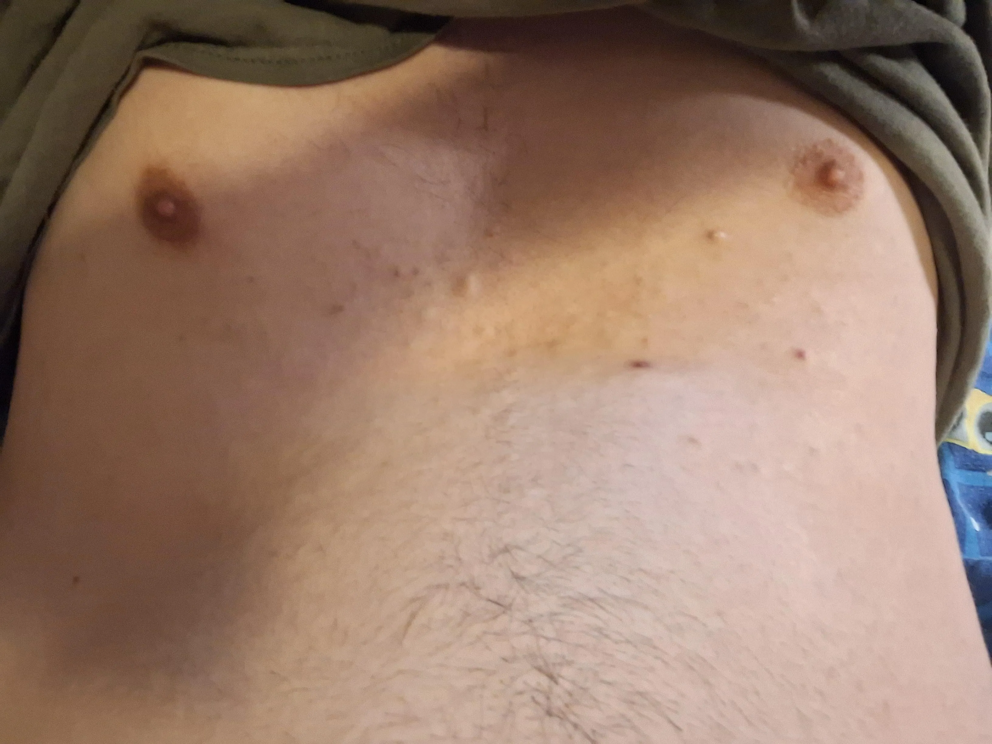 [21m] Does acne scarring count?