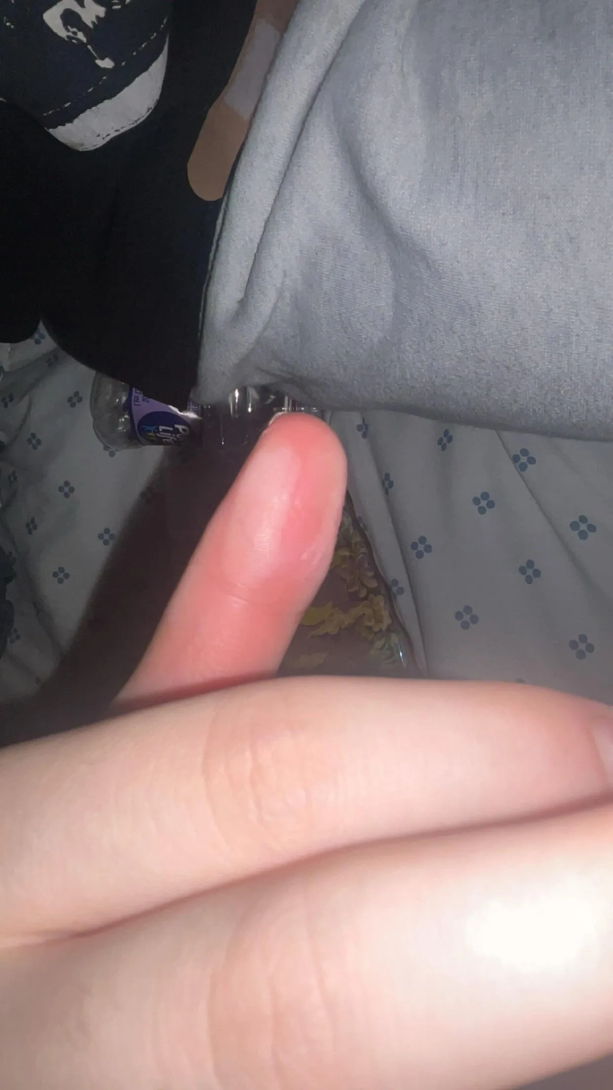 Burn advice? grabbed my hair straightener on 450 degrees because i thought it had automatically turned off.