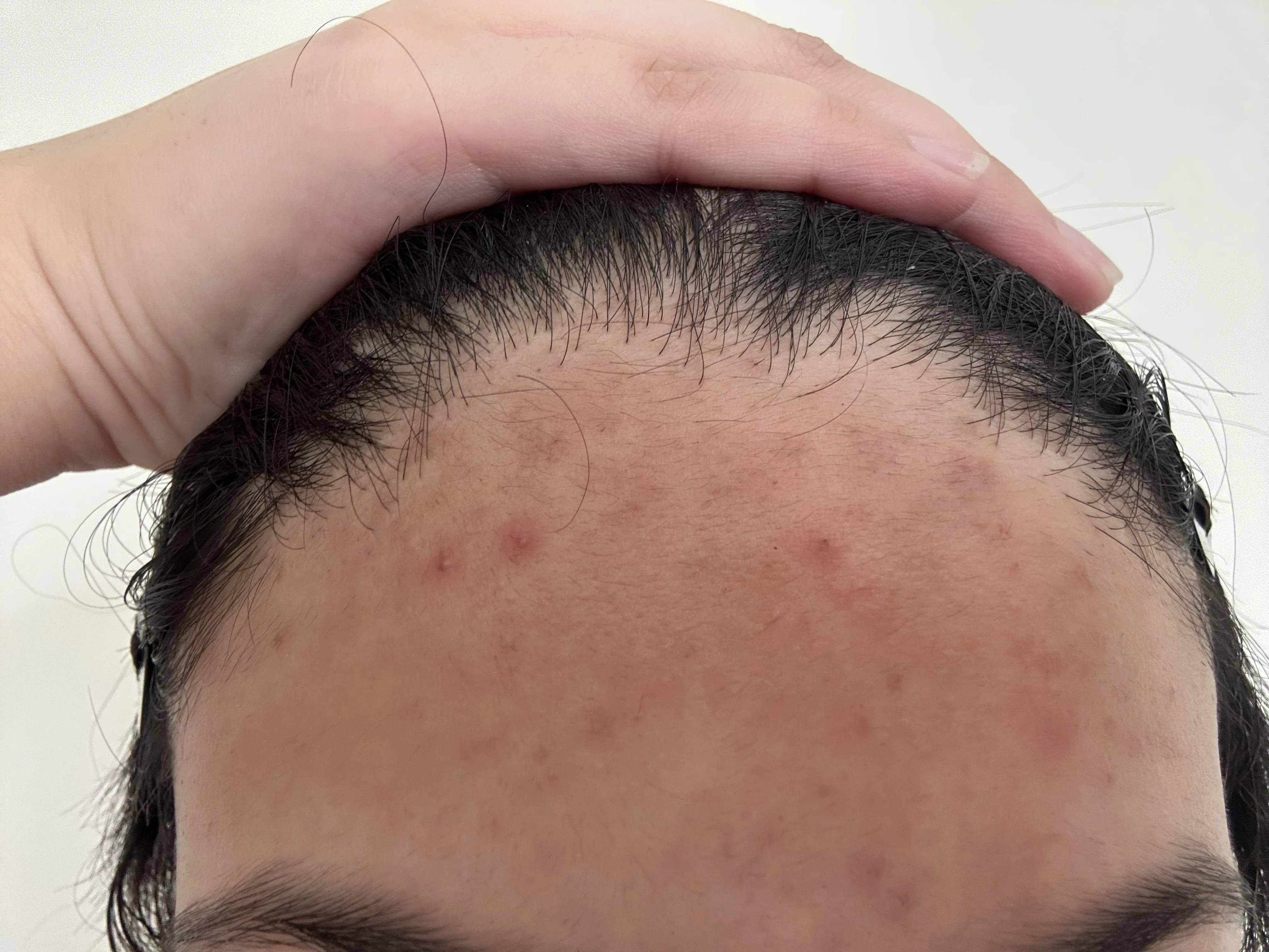 how do i get rid if this acne and the scarring