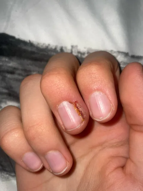 I got this injury today at work on my finger, a good chunk of skin was taken off and there is a relatively deep cut for a finger, does this look normal?