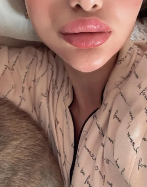 5ml lip fillers🥰