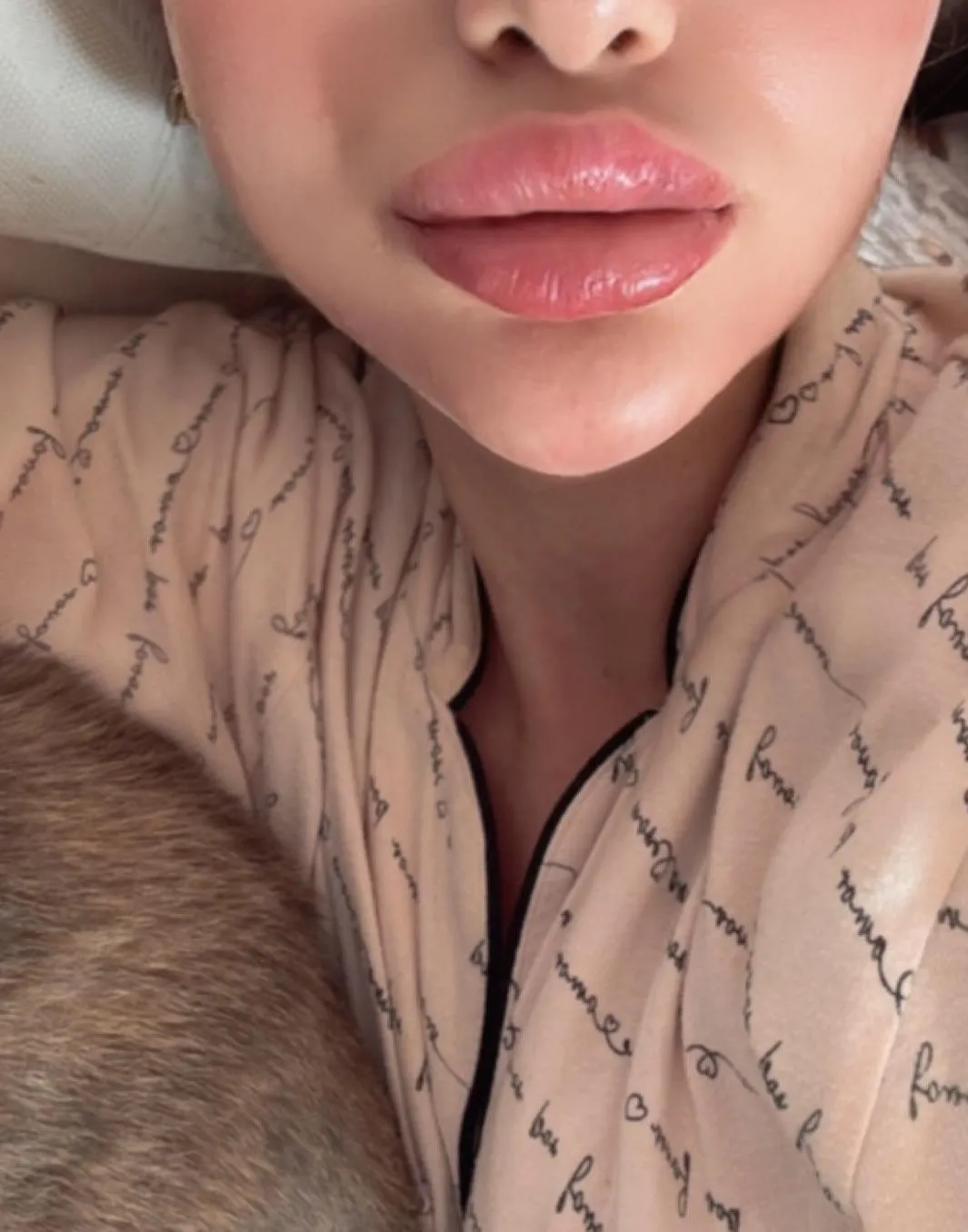 5ml lip fillers🥰