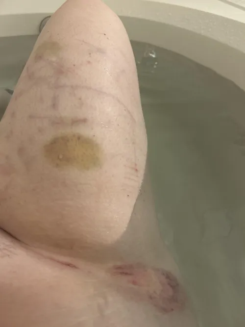 Bruised, Bitten, and Scratched