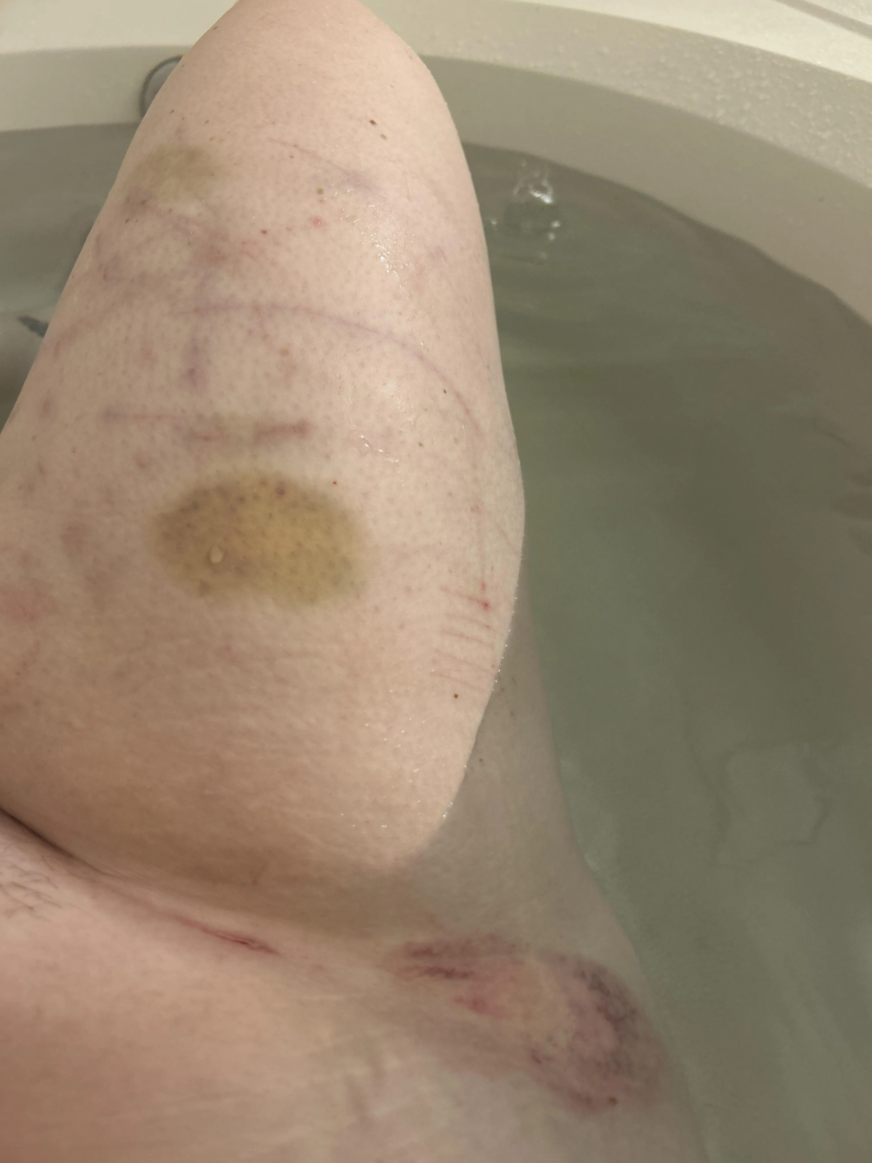 Bruised, Bitten, and Scratched