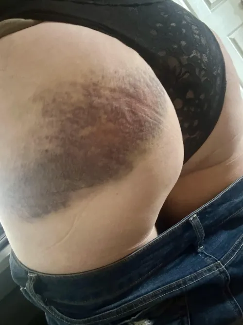 A little bruised, a little sore… but  worth it.