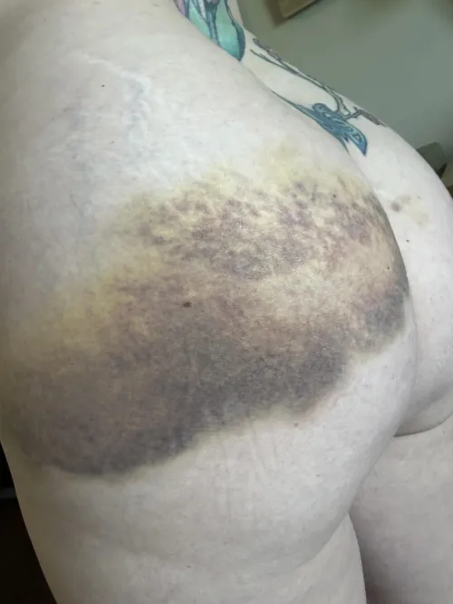 It’s starting to heal. Who wants to make this bruise darker