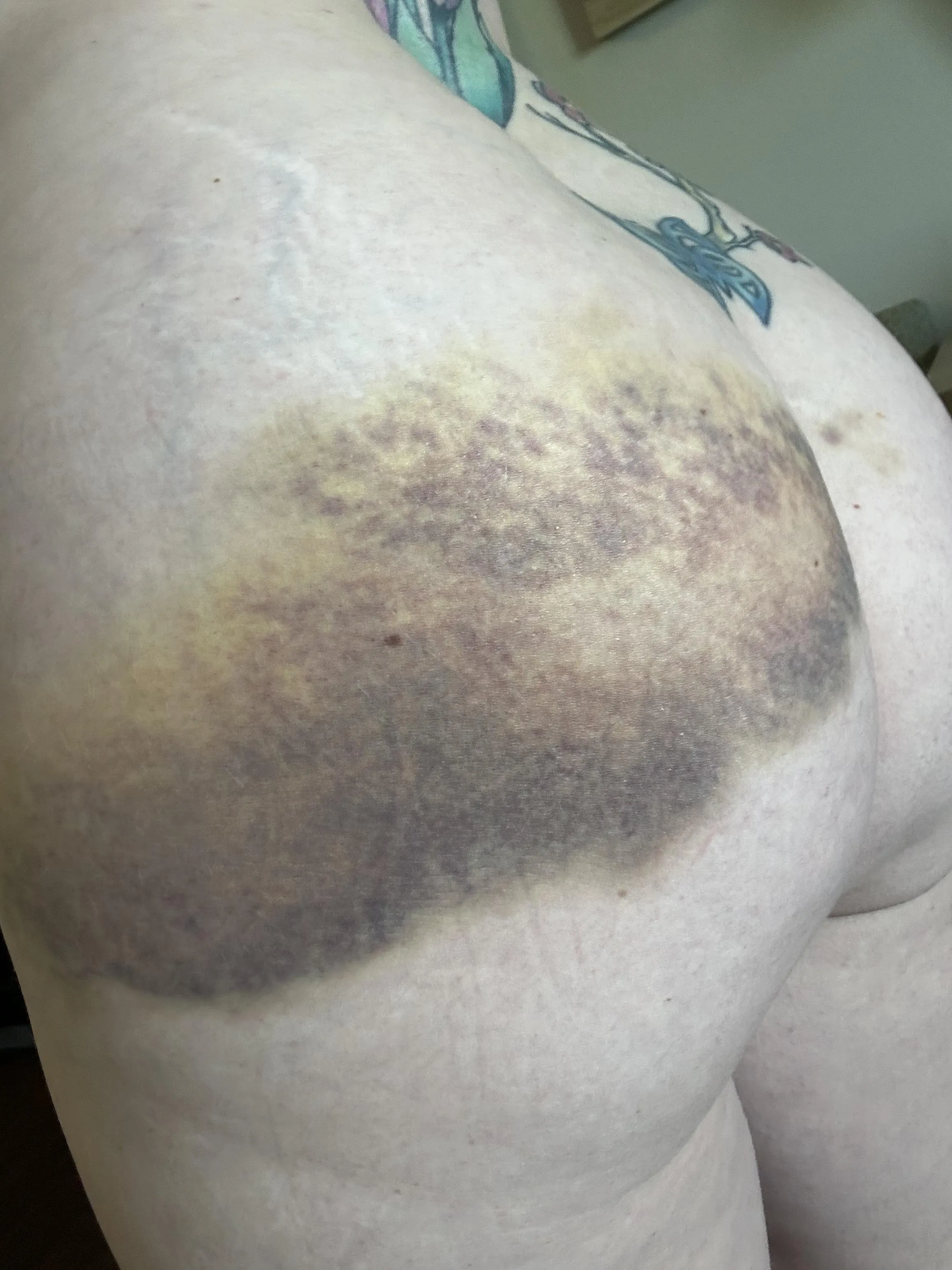 It’s starting to heal. Who wants to make this bruise darker