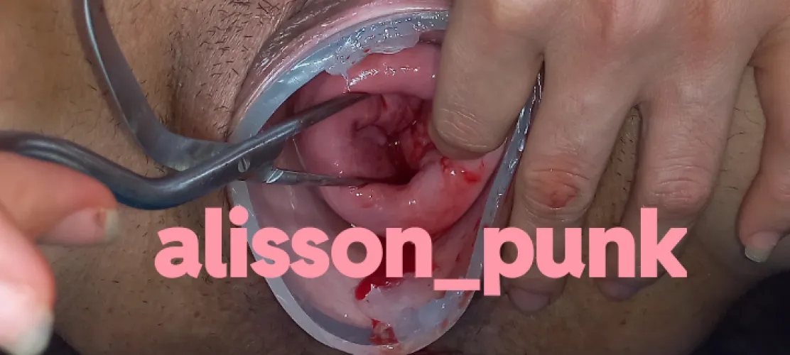 Cervix extrem unico e inolvidable