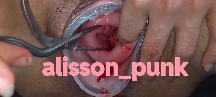 Cervix extrem unico e inolvidable