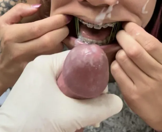Ortho cumming on patient’s braces