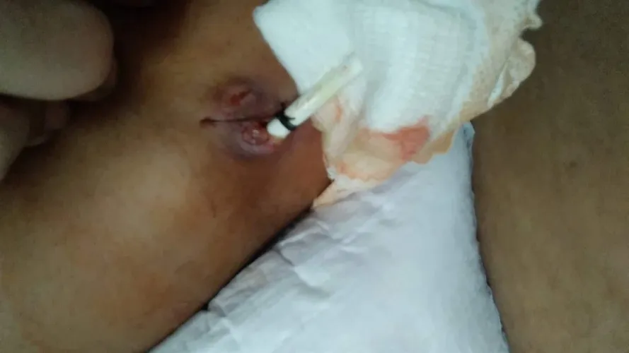 My nephrostomy tube 4/25/24