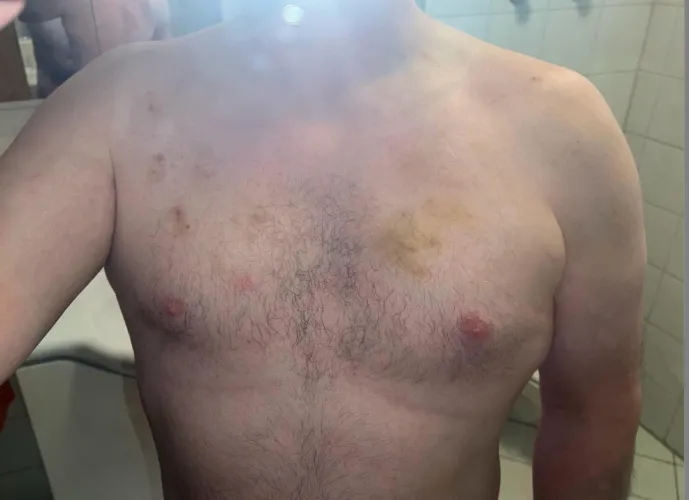 Bite [M]arks She Left This Weekend