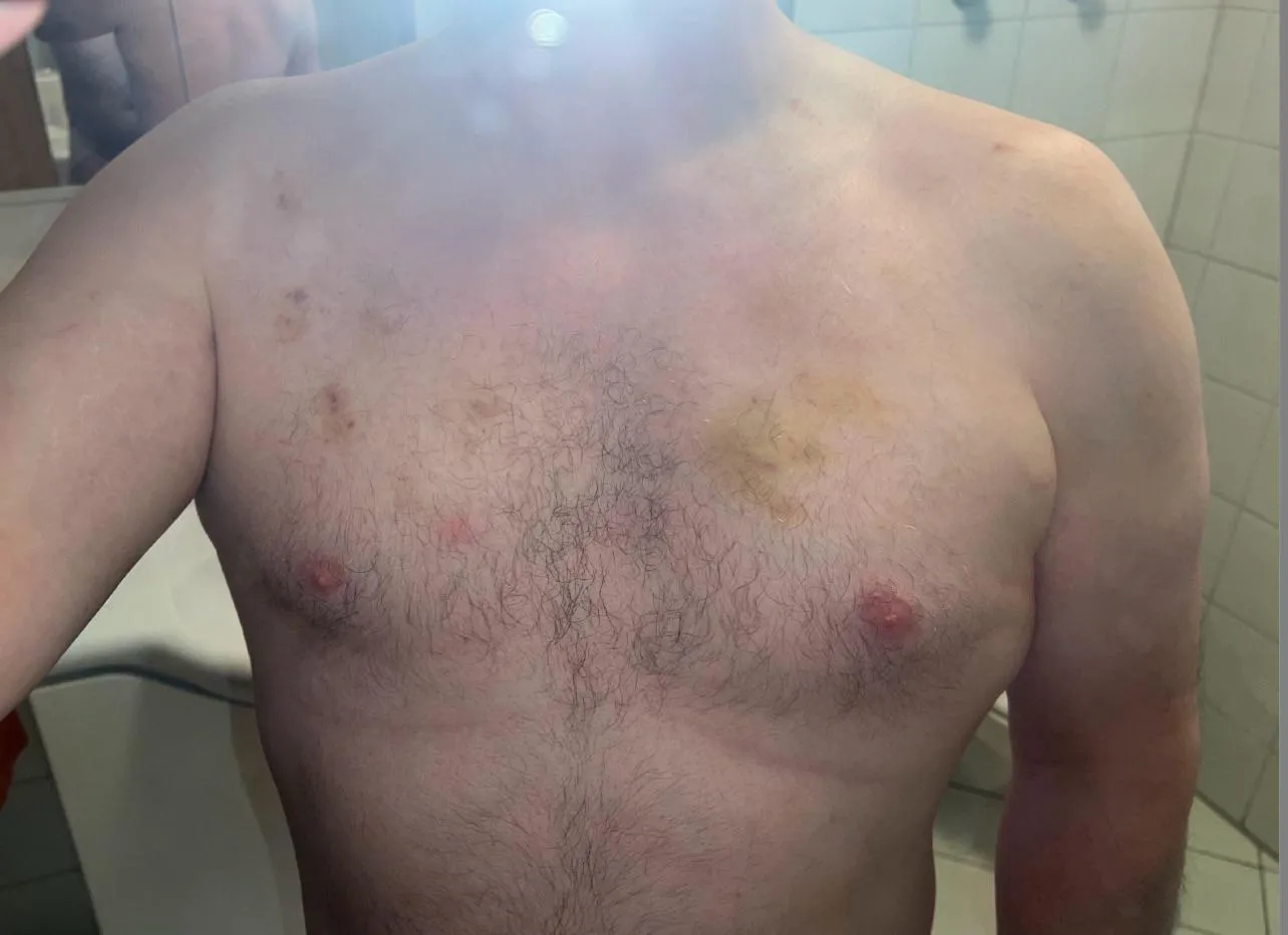 Bite [M]arks She Left This Weekend