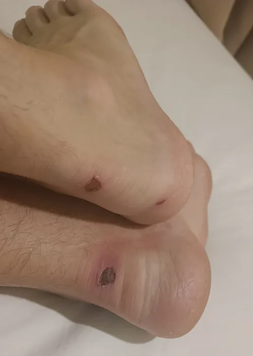 11 scuba dives with poorly-fitting flippers