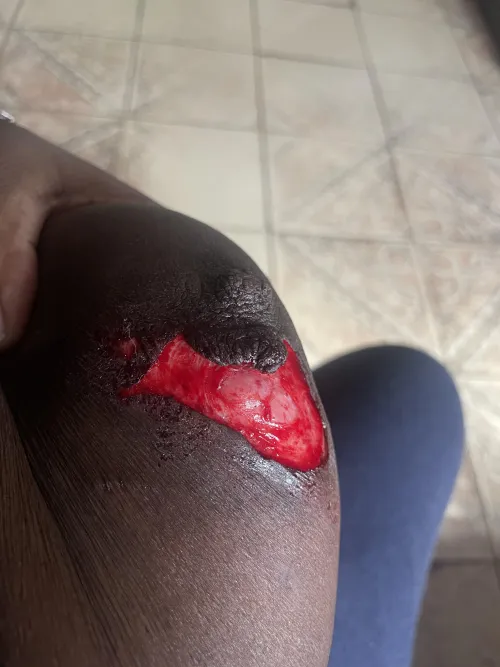 A random dog bit me today