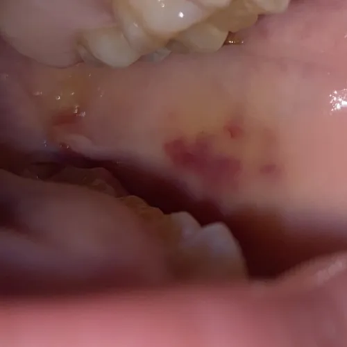 bruise on the inside of my mouth after wisdom tooth removal