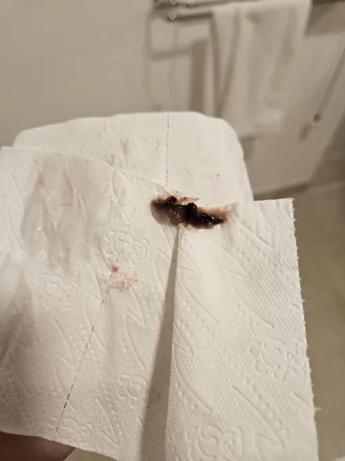 ive had this weird thing stuck in my nose and came out like this