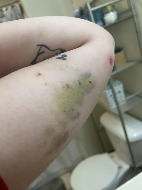 nexplanon insertion site