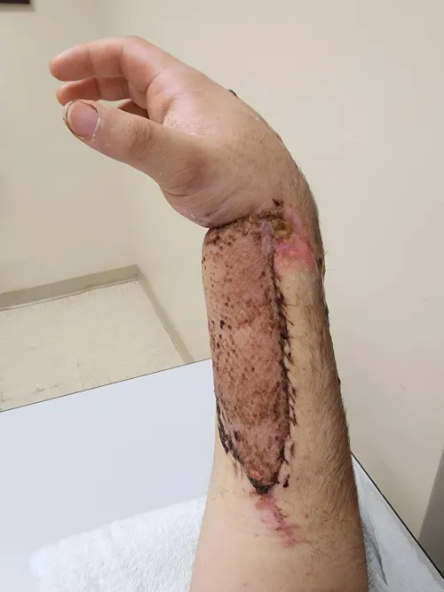 Skin graft because of an ATV accident I had on Easter Sunday