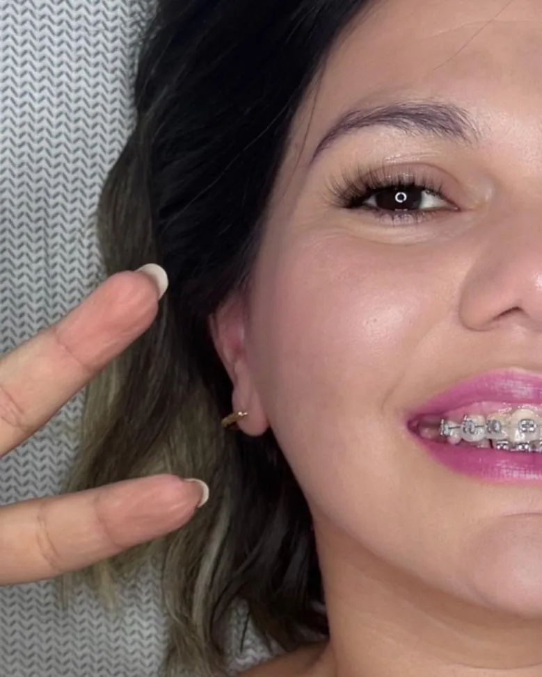 Mis bracets con bandas celestes