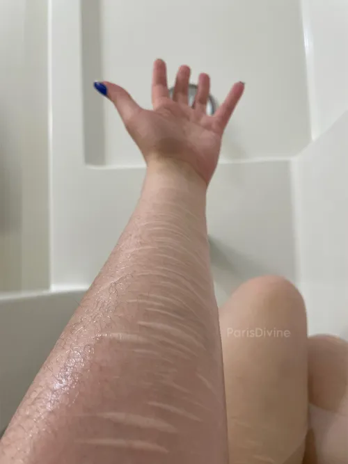 13 years of scars & counting 💓