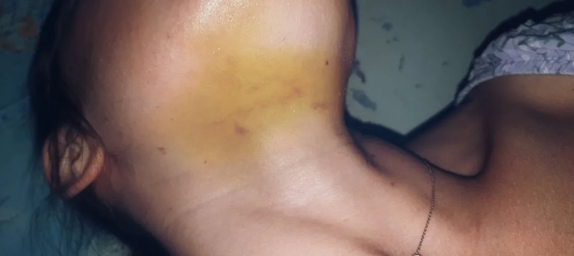 Not a common bruised part