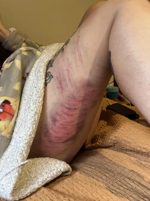 The initial bruise formed like a cloud!