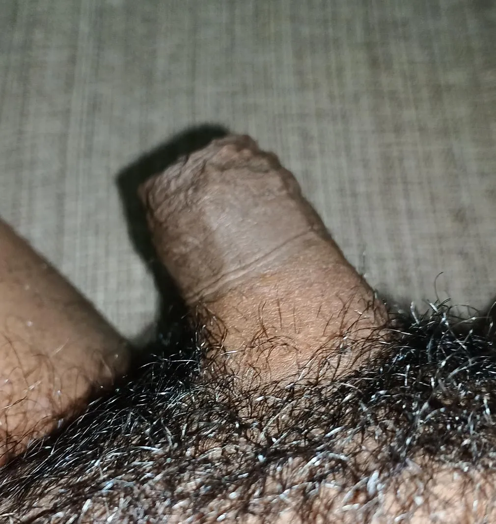 Coverage after retainer removal