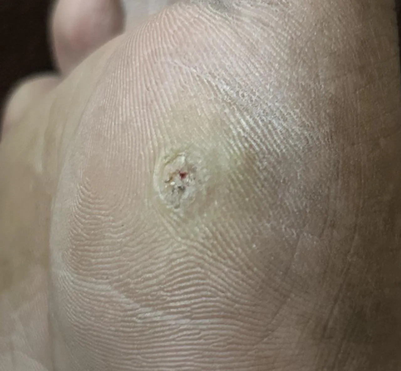 I am having this in my foot🦶 and it’s been a month, it feels hard on touch and i feel pain when i stand on it, is it something that needs attention?