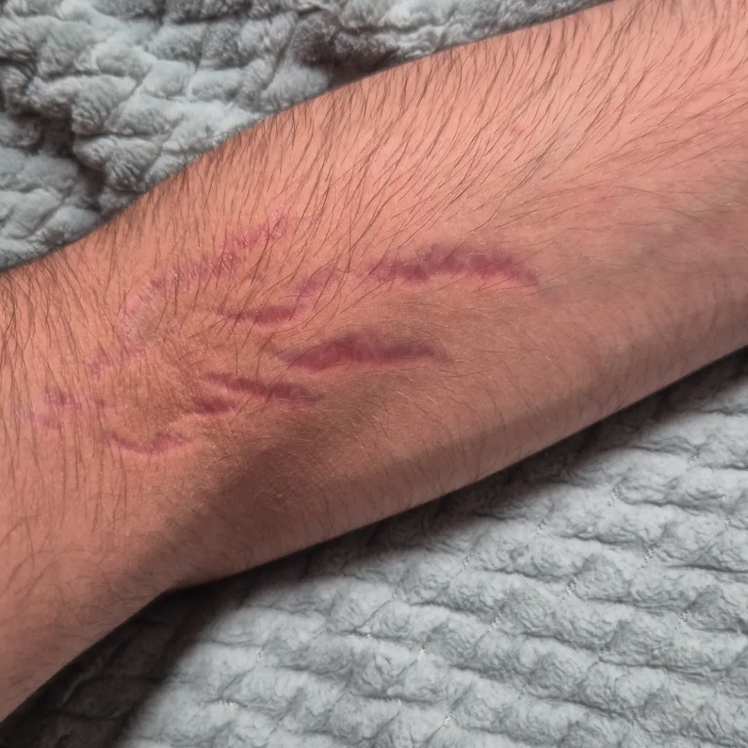 I got these marks randomly on my elbows and I don't know what they are. I have these marks on my shoulders and also on my calves. I've had them for a couple months now.