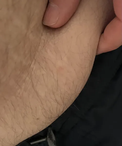 I have this pouch of skin my lower stomach . I am wondering what it could be