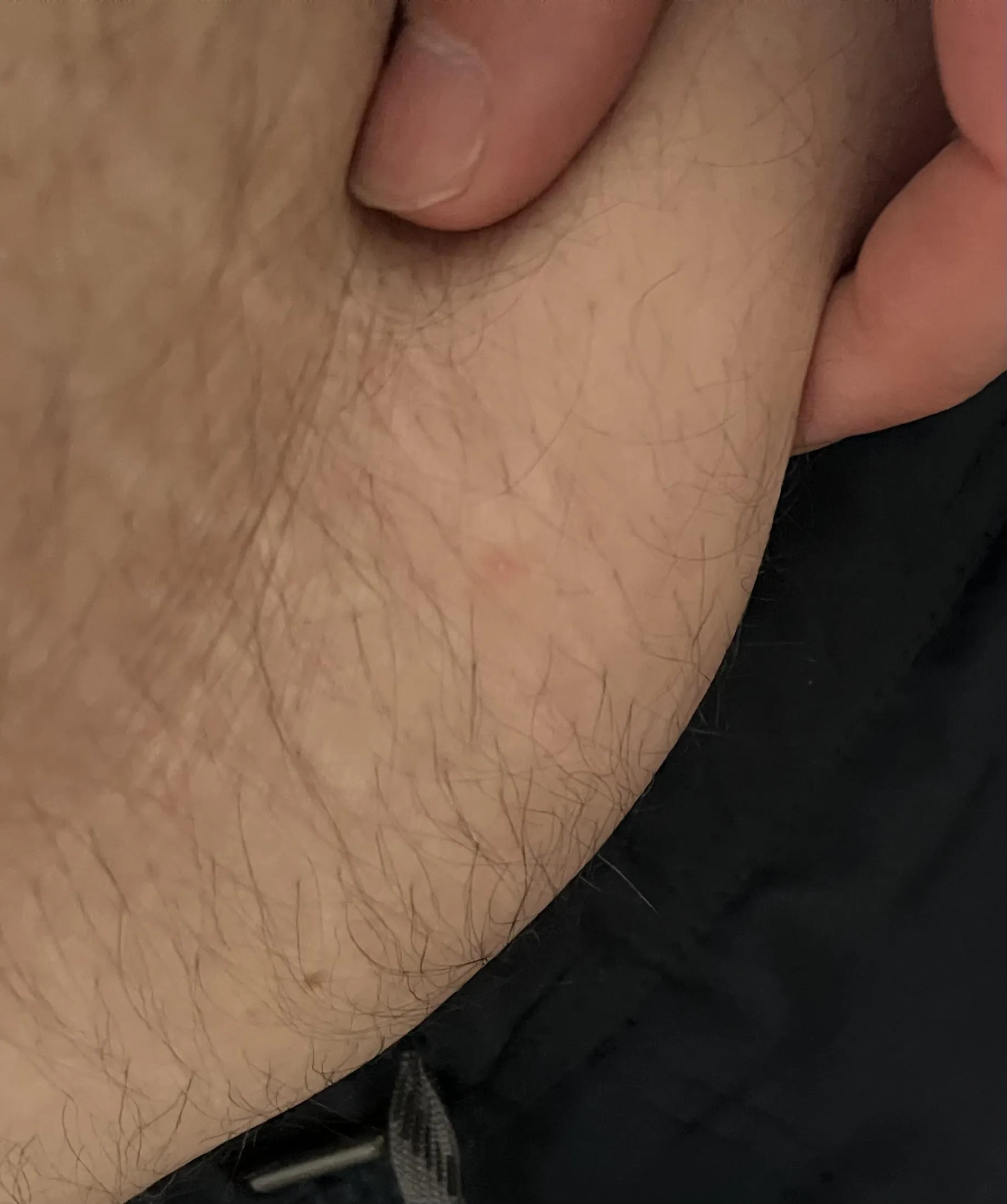 I have this pouch of skin my lower stomach . I am wondering what it could be