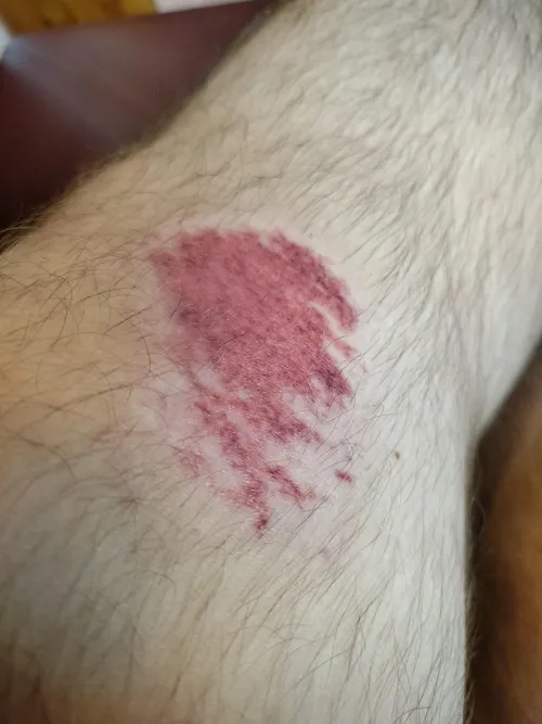 I scraped my knee near the beginning of July and now it looks like this, is it going to scar?